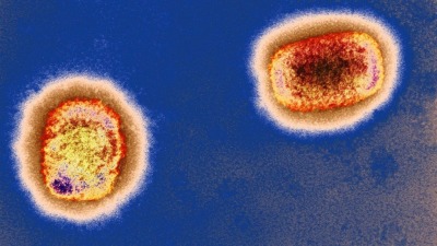世衞組織：天花疫苗對猴痘病毒有效性高達85%