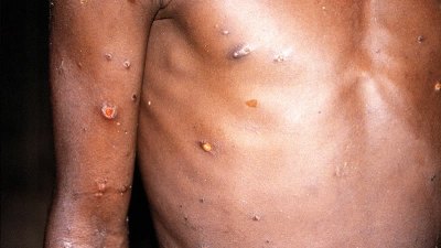 越南報告該國首例猴痘病例