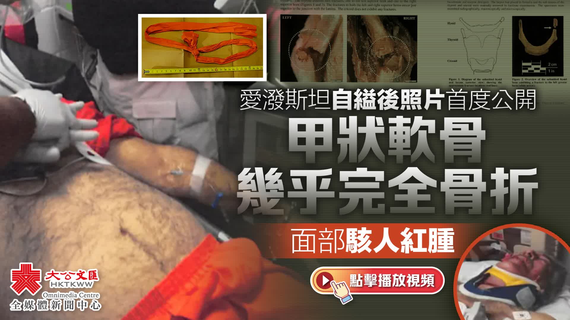 (有片)愛潑斯坦自縊後照片首度公開 甲狀軟骨幾乎完全骨折 面部駭人紅腫