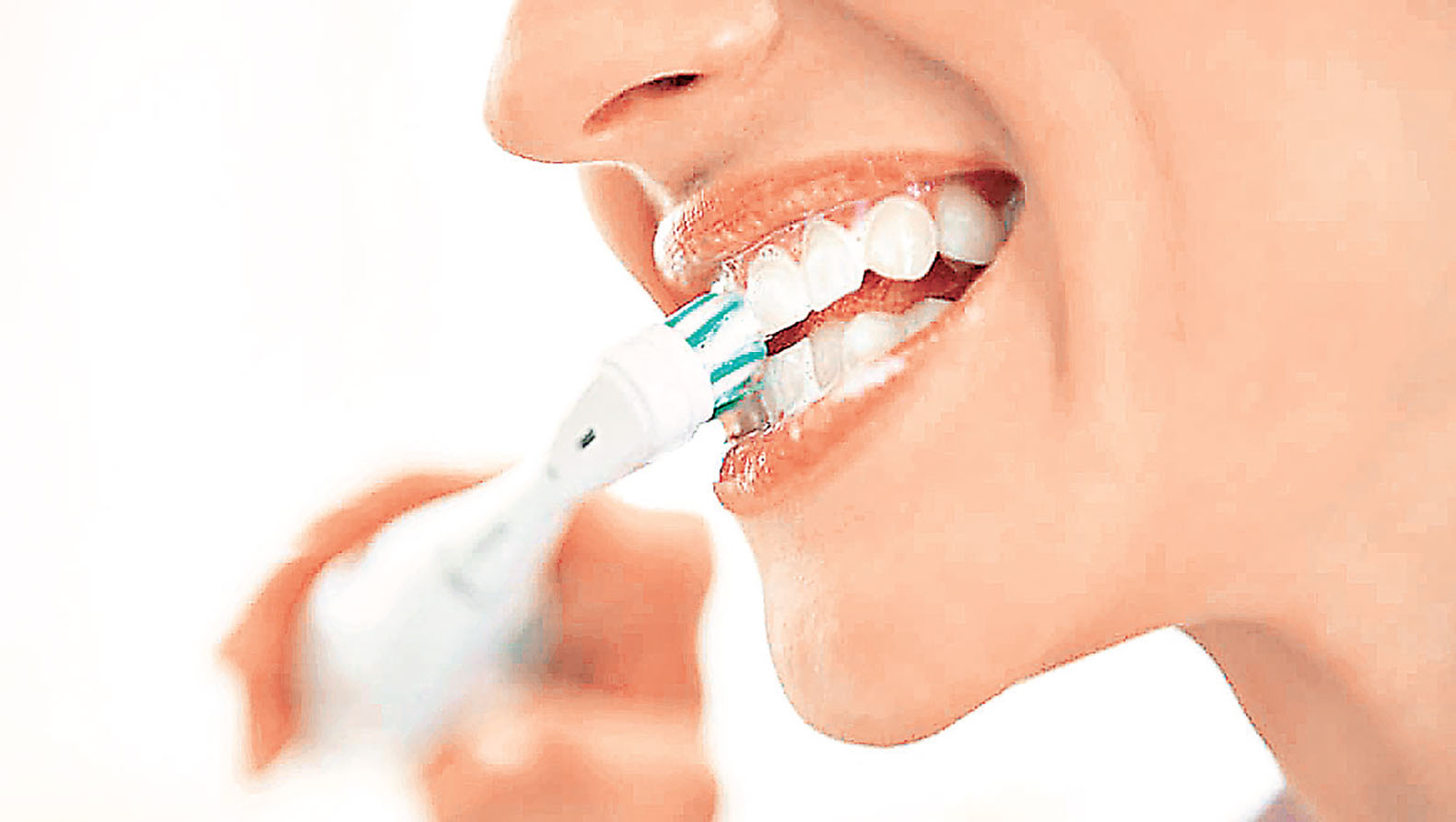 ■箍牙後更須注意牙齒及口腔清潔。