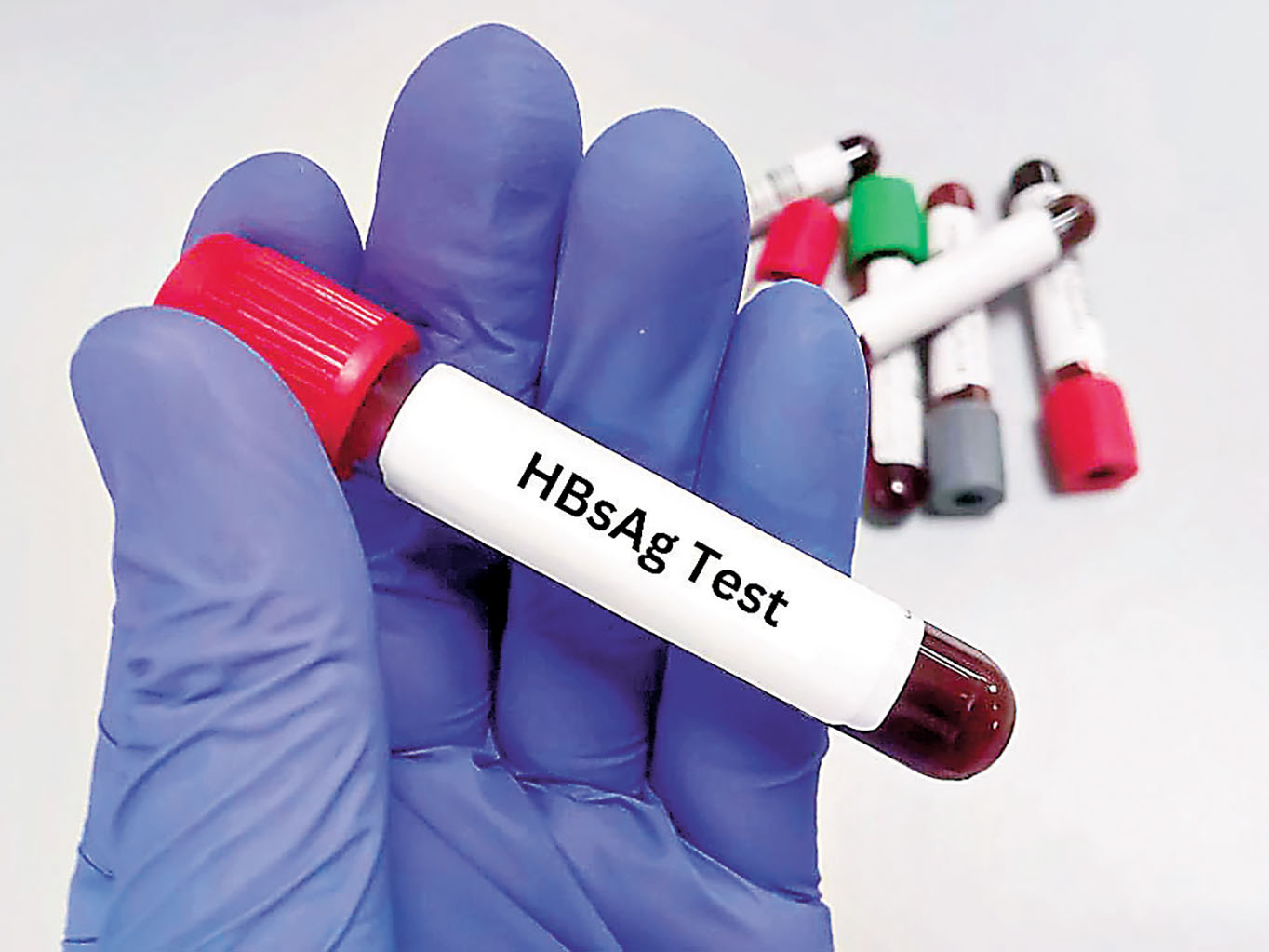 ■HBsAg檢測有助及早發現是否乙肝患者。