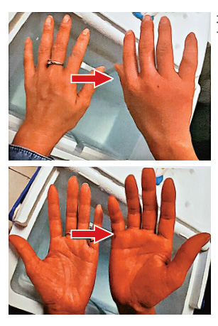 　　圖：女魚販被八爪魚咬傷右手，立即紅腫（由左至右）