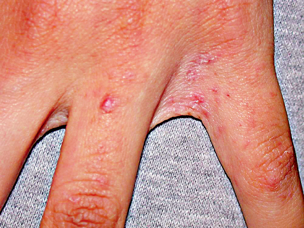 　　圖：指縫是疥瘡好發部位之一