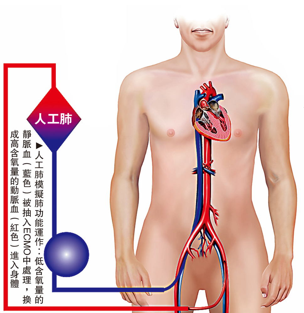　　圖：人工肺模擬肺功能運作：低含氧量的靜脈血（藍色）被抽入ECMO中處理，換成高含氧量的動脈血（紅色）進入身體
