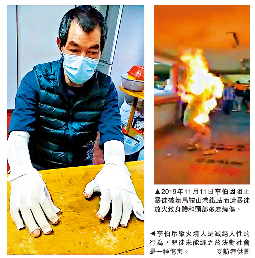 　　圖：2019年11月11日李伯因阻止暴徒破壞馬鞍山港鐵站而遭暴徒放火致身體和頭部多處燒傷。
