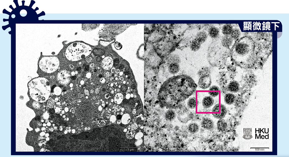 　　圖：在低倍電子顯微鏡下（圖左），感染Omicron變種病毒株後的猴腎細胞（Vero E6）受損，腫脹囊泡，且囊泡內含有黑色小病毒顆粒。而在高倍電子顯微鏡下受感染的Vero E6細胞（圖右），病毒顆粒的表面呈皇冠形的刺突蛋白（紅框示）。\港大供圖