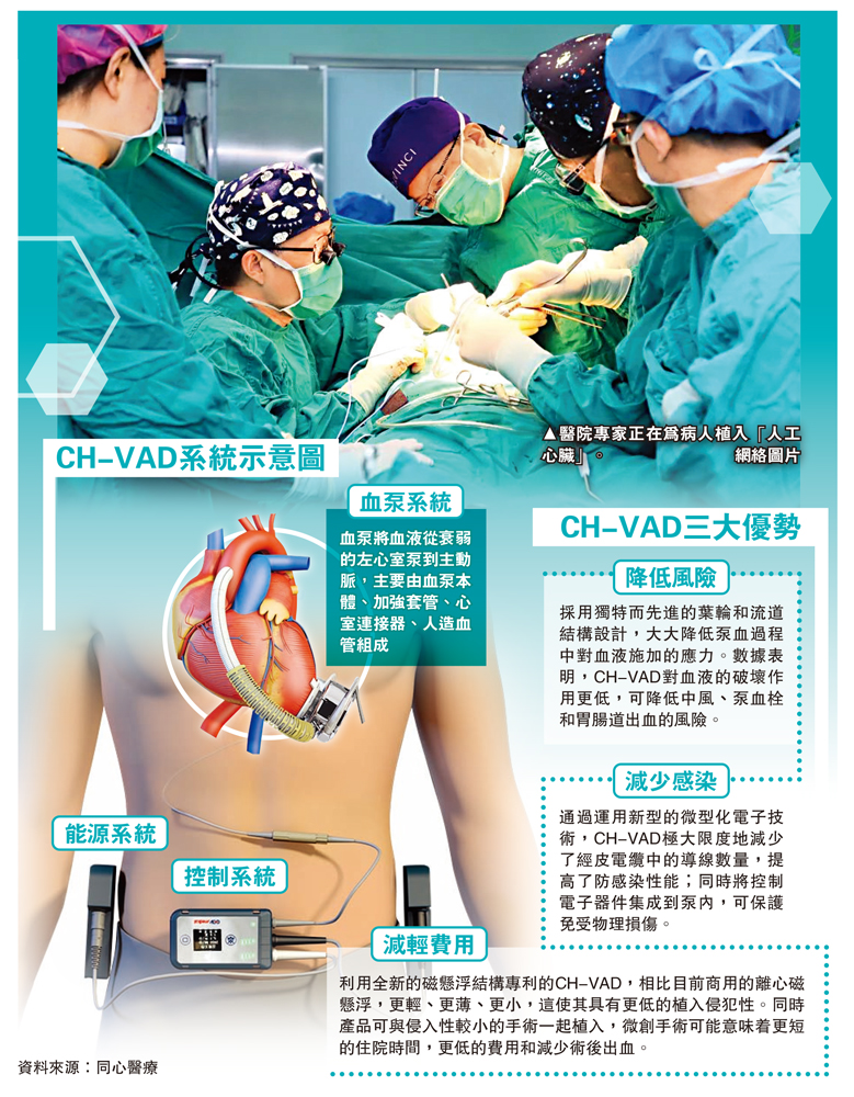 　　圖：醫院專家正在為病人植入「人工心臟」。\網絡圖片