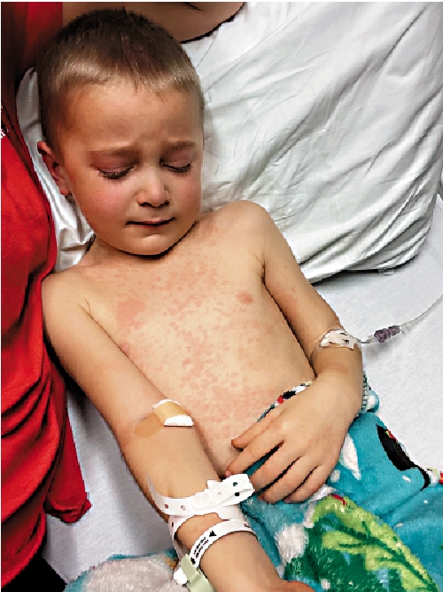 　　圖：密歇根5歲男孩哈維患上MIS-C後高燒不退，全身紅疹。/網絡圖片