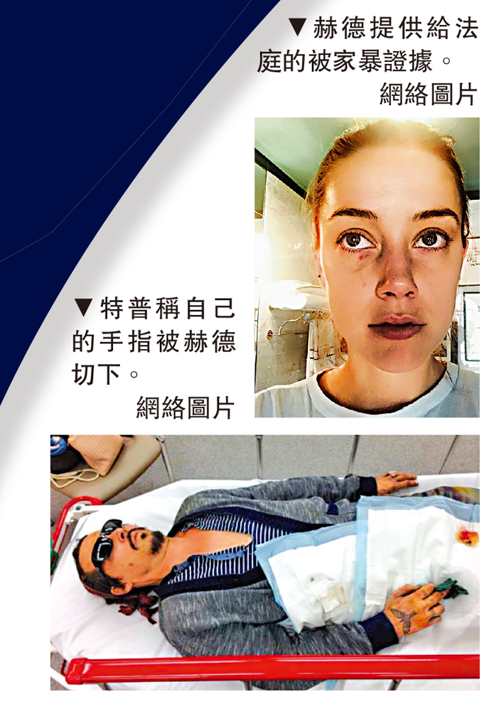　　上圖：赫德提供給法庭的被家暴證據。下圖：特普稱自己的手指被赫德切下。\網絡圖片