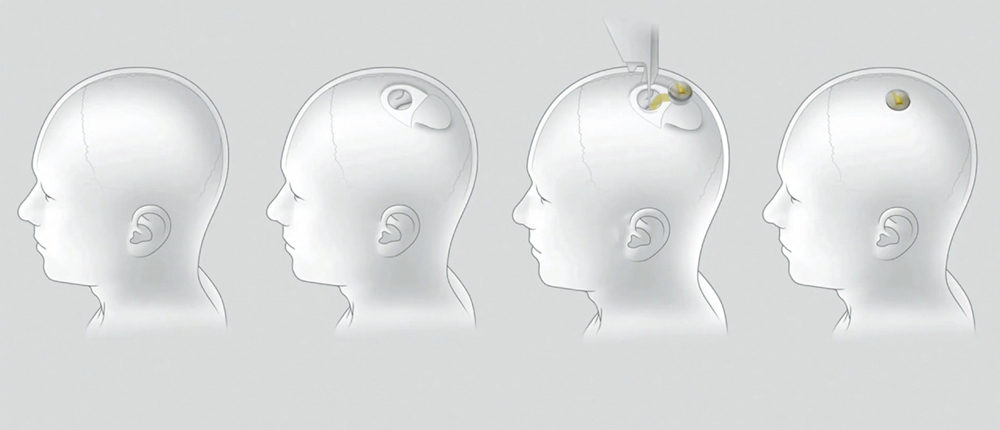 　　圖：Neuralink在2020年的發布會上展示在人類大腦植入芯片的過程。\法新社