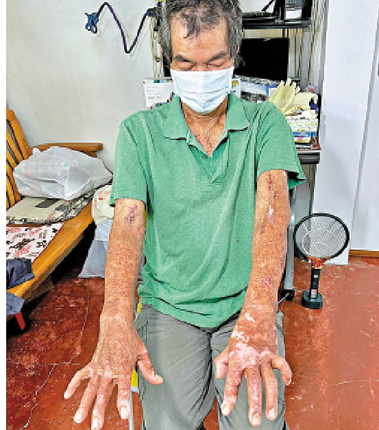 　　圖：李伯手肘關節經矯正手術後，終於可以伸直。