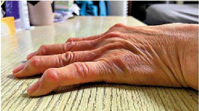 　　圖：手指關節受傷後須及時處理，以免關節腫脹變形。