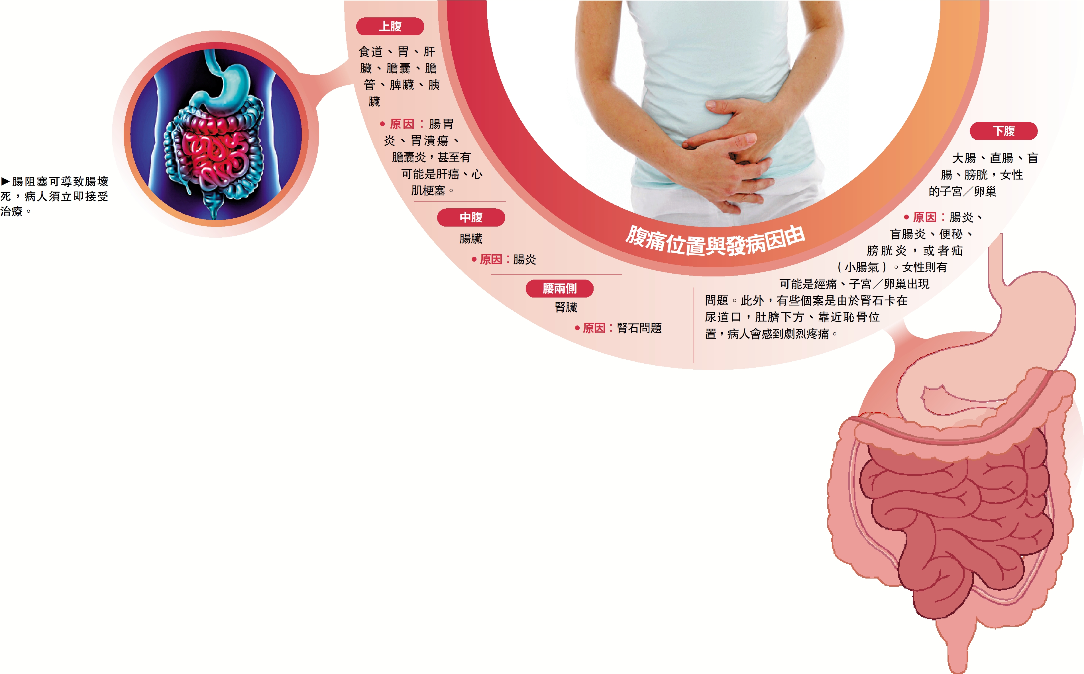 　　圖：腸阻塞可導致腸壞死，病人須立即接受治療。