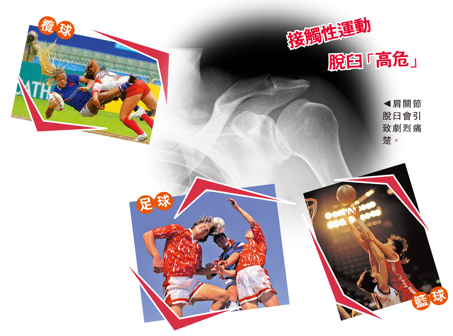 　　圖：接觸性運動 脫臼「高危」