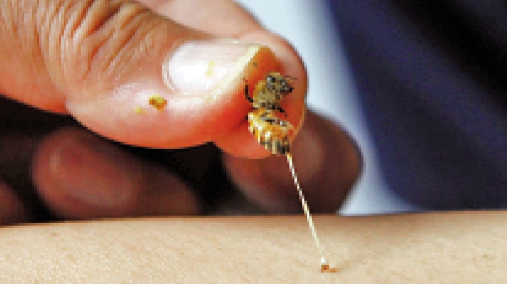 　　圖：蜂針療法利用蜜蜂尾部螫針及運用針灸方式刺入人體穴位，聲稱可治療疾病。