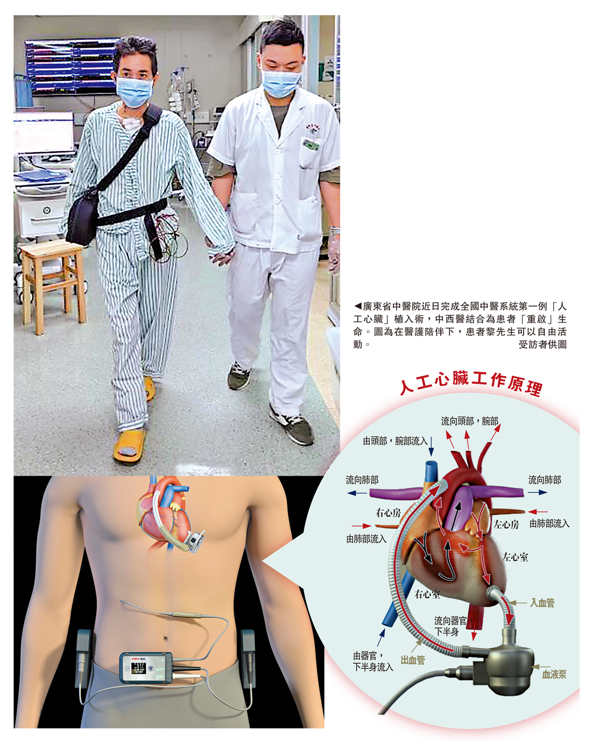 　　圖：廣東省中醫院近日完成全國中醫系統第一例「人工心臟」植入術，中西醫結合為患者「重啟」生命。圖為在醫護陪伴下，患者黎先生可以自由活動。\受訪者供圖