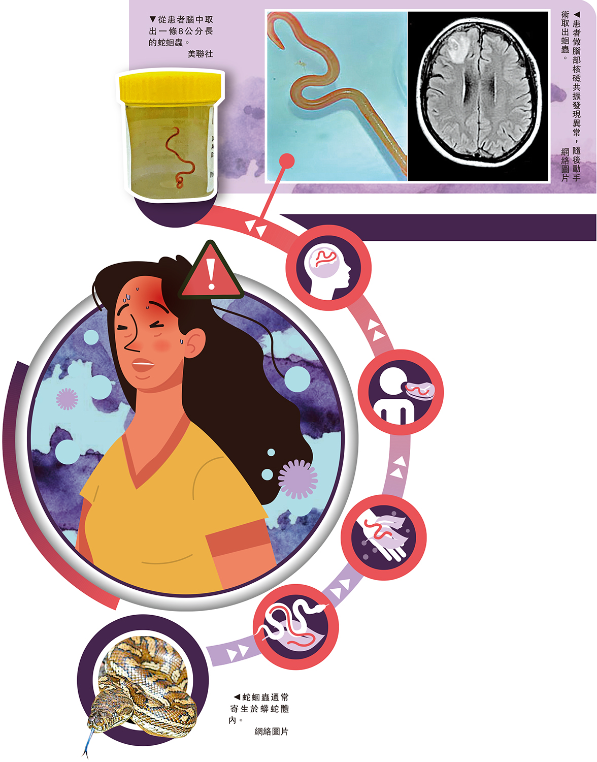 　　左圖：從患者腦中取出一條8公分長的蛇蛔蟲。\美聯社；右圖：患者做腦部核磁共振發現異常，隨後動手術取出蛔蟲。\網絡圖片