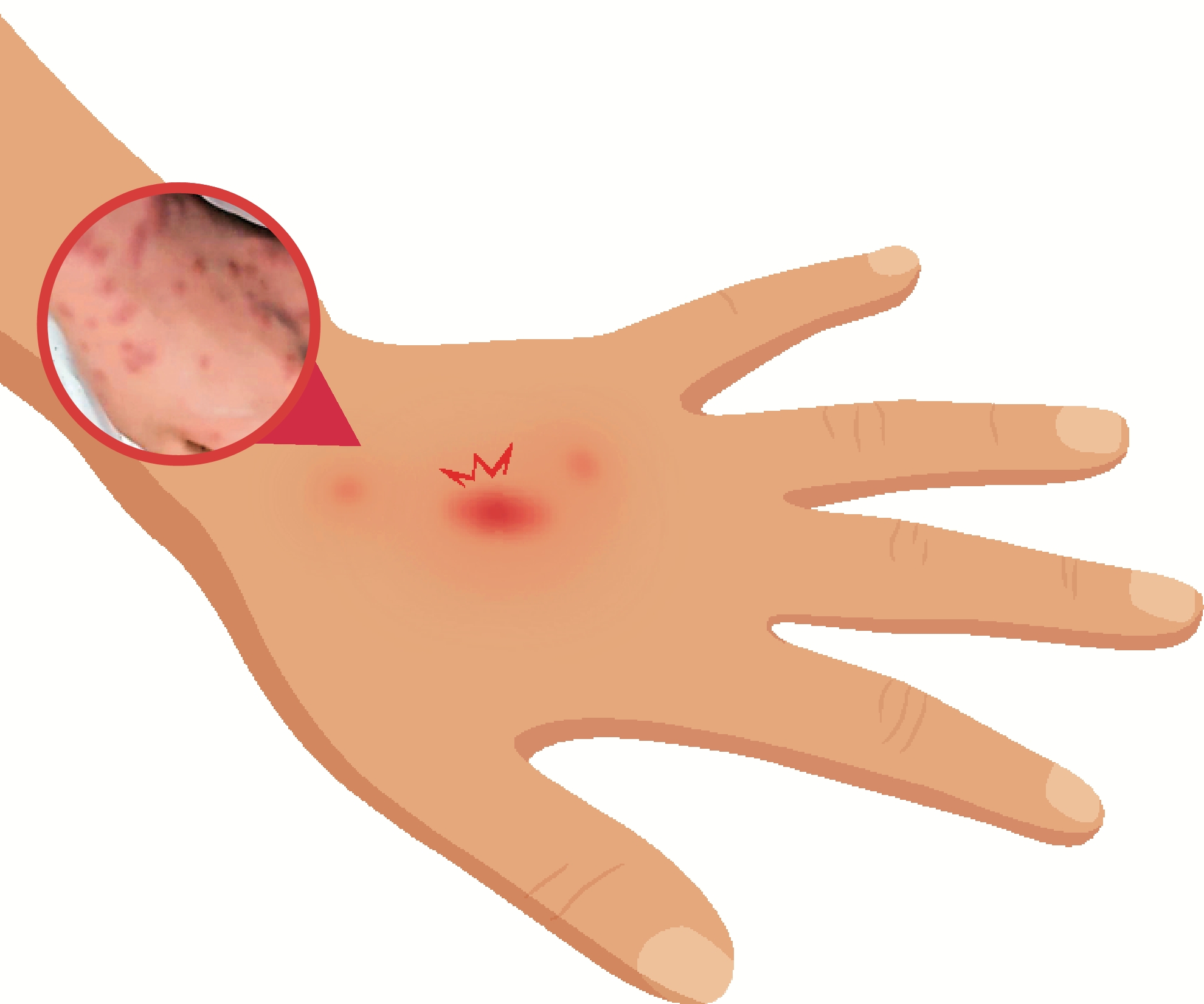 　　圖：韓國網民上傳自己在酒店被床蝨叮咬的照片。\網絡圖片