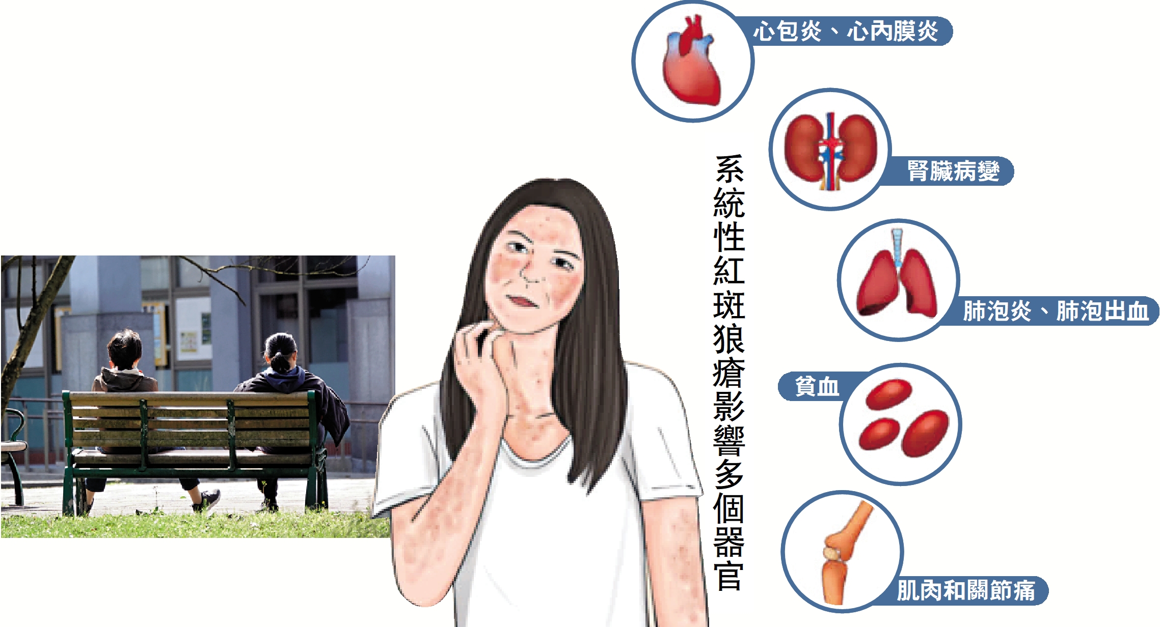 　　圖：紅斑狼瘡患者以女性為多。