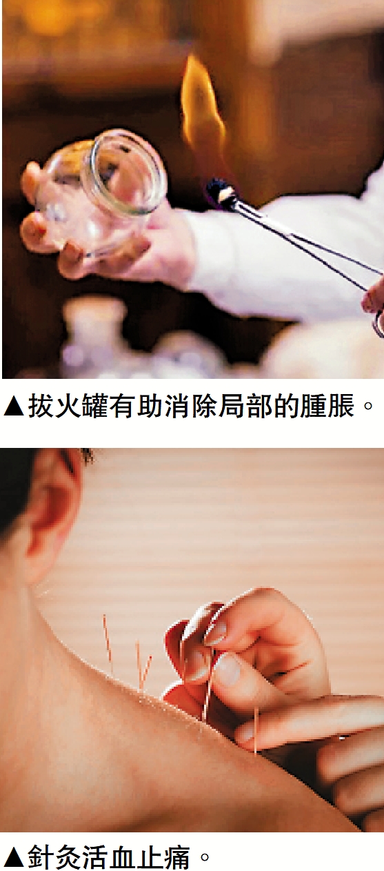 　　上圖：拔火罐有助消除局部的腫脹。下圖：針灸活血止痛。