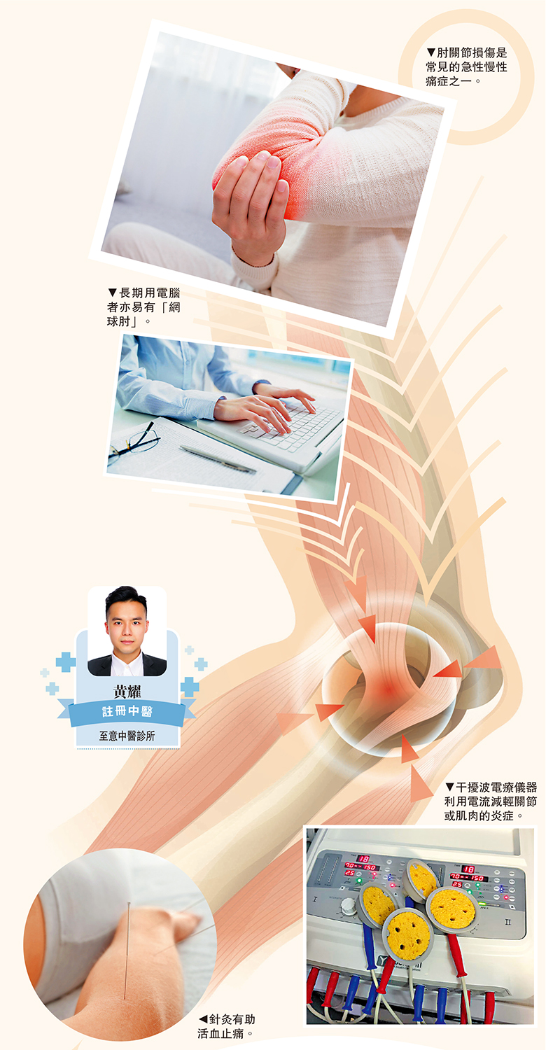 　　圖：（上）肘關節損傷是常見的急性慢性痛症之一。（中）長期用電腦者亦易有「網球肘」。（左下）干擾波電療儀器利用電流減輕關節或肌肉的炎症。（右下）針灸有助活血止痛。