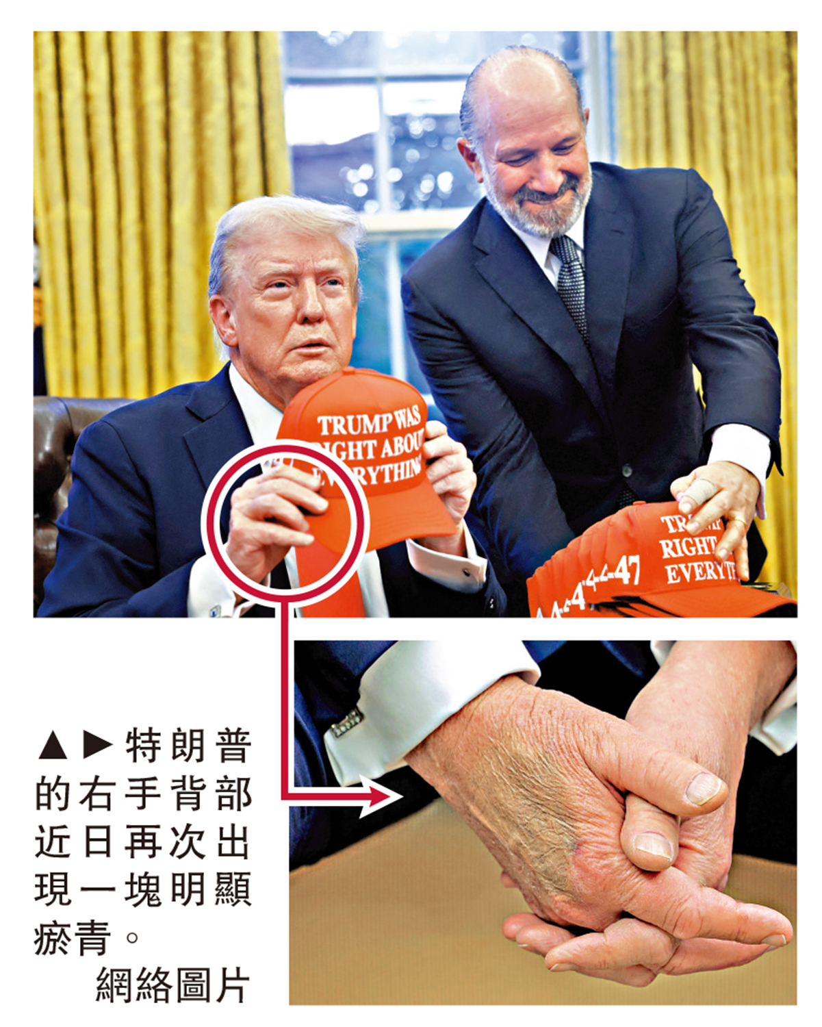 圖:特朗普的右手背部近日再次出現一塊明顯瘀青。\網絡圖片