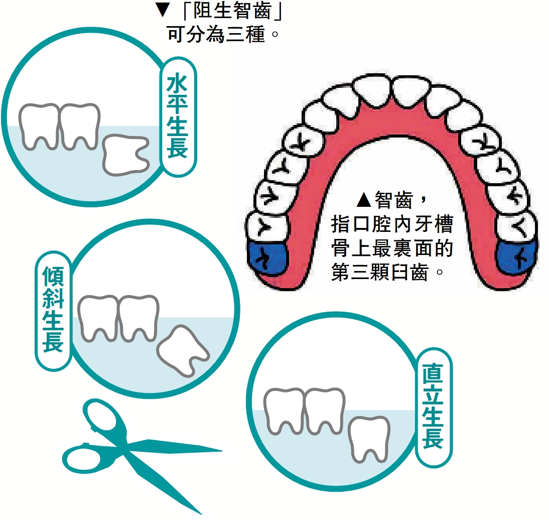 　　圖：智齒是拔還是留？ 牙醫拆解迷思護齒有法
