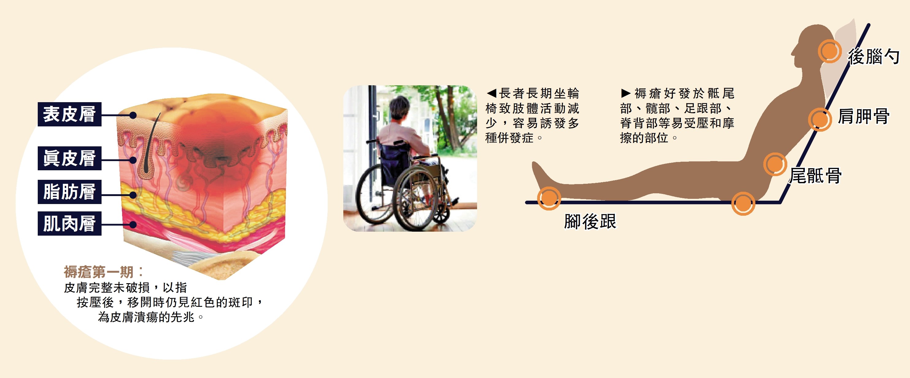 左圖:長者長期坐輪椅致肢體活動減少,容易誘發多種併發症。右圖:褥瘡好發於骶尾部、髖部、足跟部、脊背部等易受壓和摩擦的部位。