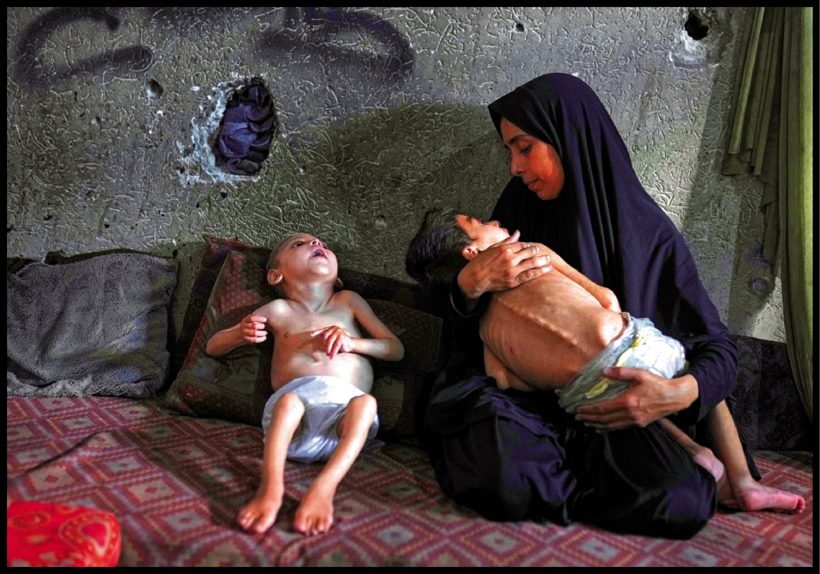 　　圖：兩名加沙兒童分別患有營養不良和腦癱，食物短缺和糟糕的衞生條件加劇其疾病程度。\美聯社