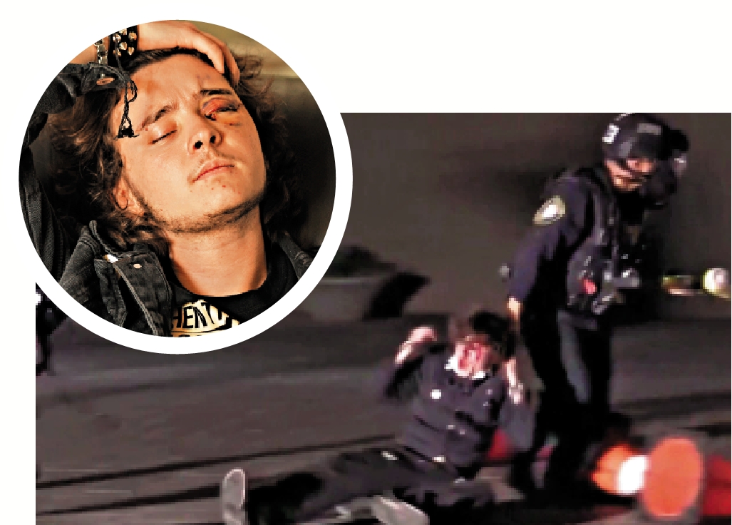 　　圖：魯姆勒在加州示威期間，遭ICE執法人員近距離擊中臉部，左眼永久失明。\美聯社