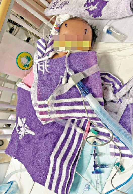 　　圖：四個月大的「細波」疑受虐致腦出血，現時留醫兒童深切治療部。