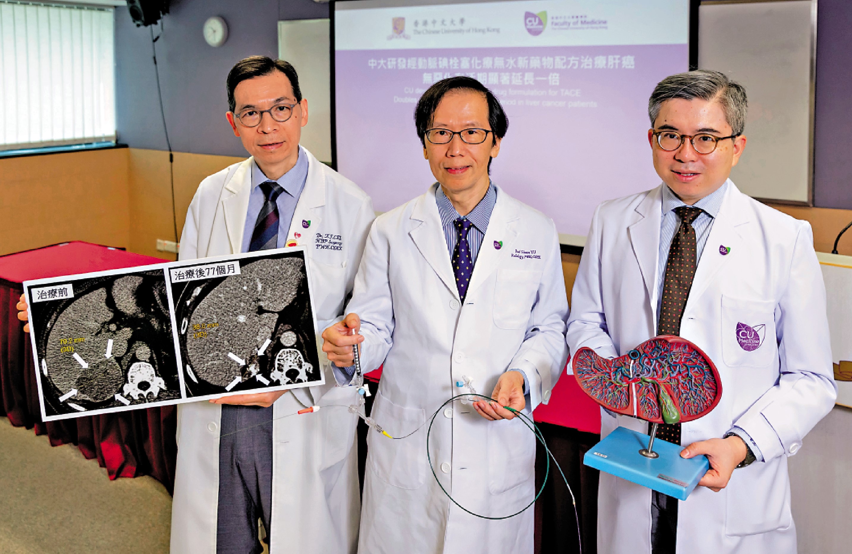 　　圖：中大醫學院於傳統「經動脈碘栓塞化療」基礎上，研發出以無水純化療藥新配方。