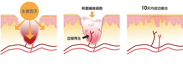 ■在傷口位置塗上生長因子後,生長因子會滲透在傷口裡,加快皮膚新陳代謝率和激活修復肌膚組織功能,使組織和血管再生。