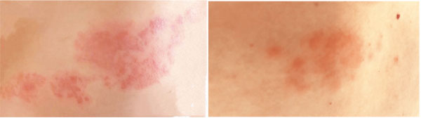 ■左圖是沒有打帶狀皰疹疫苗的朋友。右圖是幾年前打了帶狀皰疹疫苗的朋友。 作者供圖