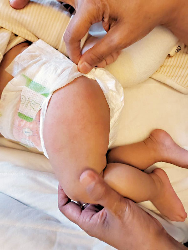 ■這些紅色的疹上有凹凸的粒粒就是熱痱。 作者供圖