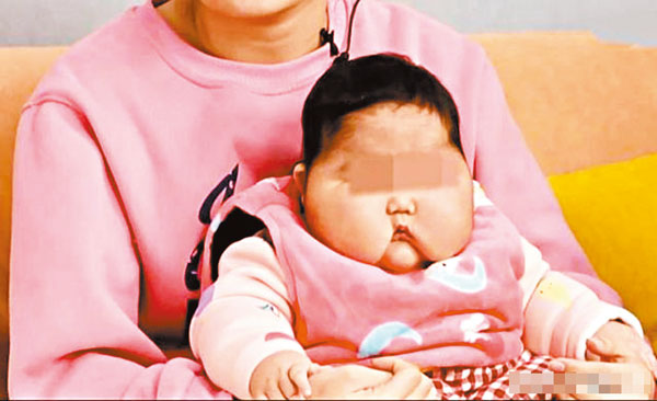 ●早前不滿一歲的女嬰使用了在江蘇連雲港市一家母嬰店購買的「益芙靈多效特護抑菌霜」後出現多毛、臉部腫大等症狀。 網上圖片