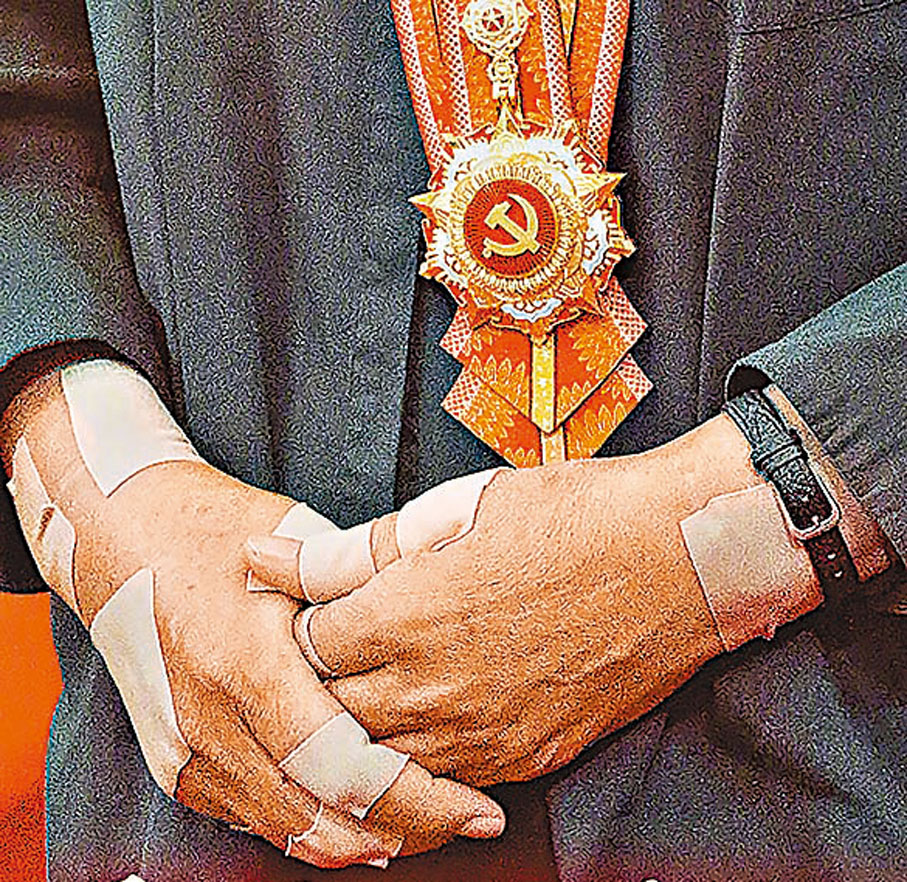 ●張桂梅貼滿膏藥的雙手令無數網友淚目。網上圖片