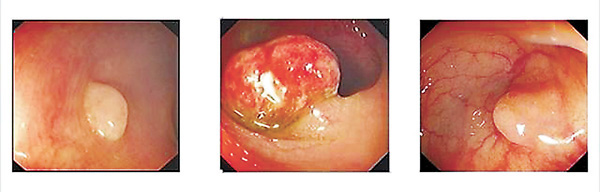 ●（左至右）增生性瘜肉、腺瘤性瘜肉和鋸齒狀瘤。