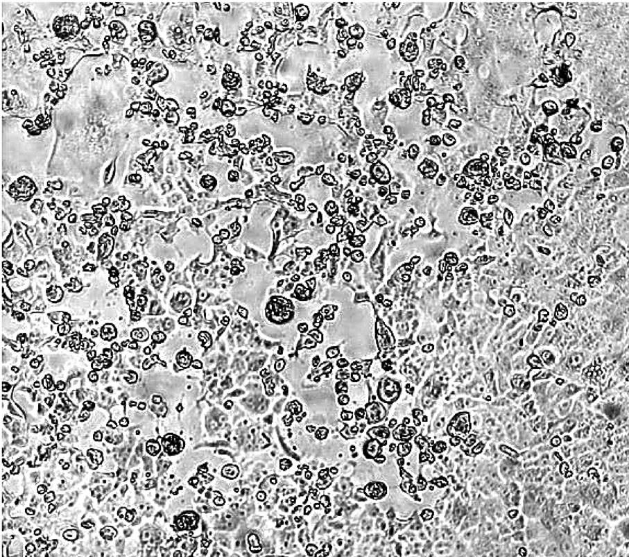 ● Omicron變種病毒在混合了科興疫苗接種者的血清之後依然有毒性，有很明顯的細胞病變作用（CPE），細胞大量死亡。 港大微生物學系團隊供圖