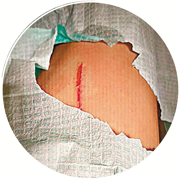 ● 衛詩雅傷痕清晰可見。