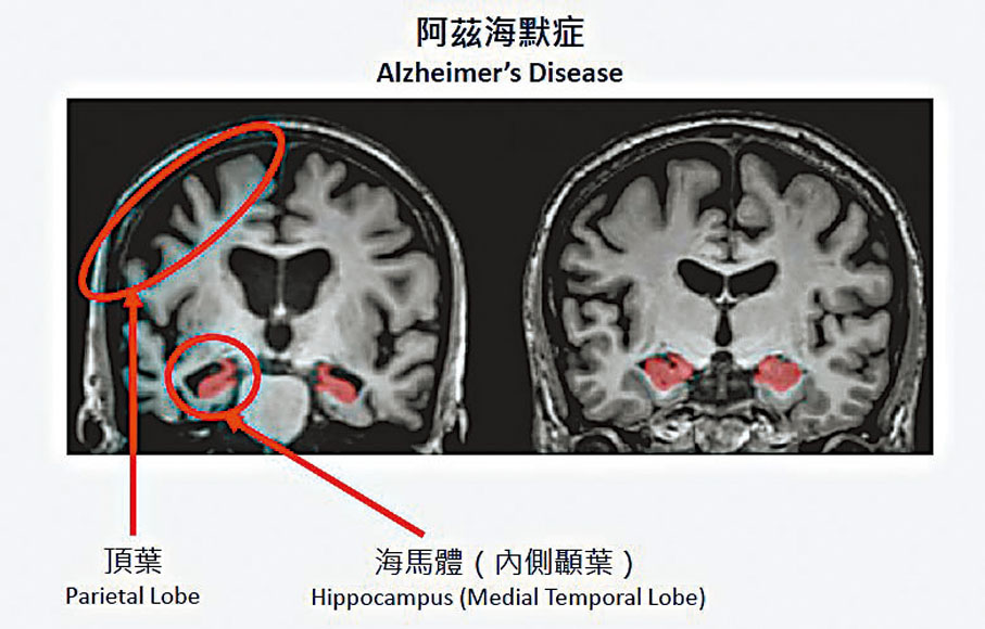 ●阿茲海默症患者的頂葉及海馬體（左）較正常大腦（右）萎縮。中大供圖