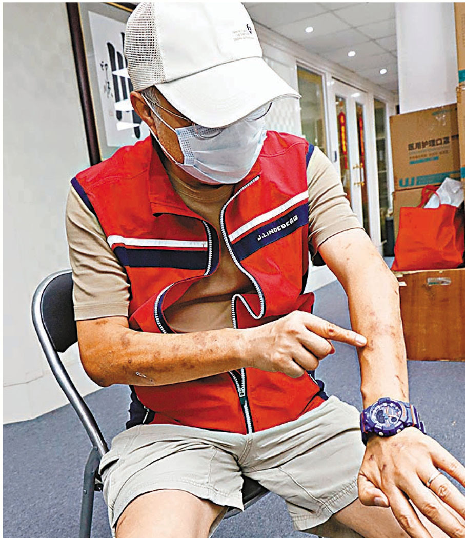 ◆的士司機鄭國泉2020年接受香港文匯報訪問時，手部仍留下清晰可見的傷疤。 資料圖片