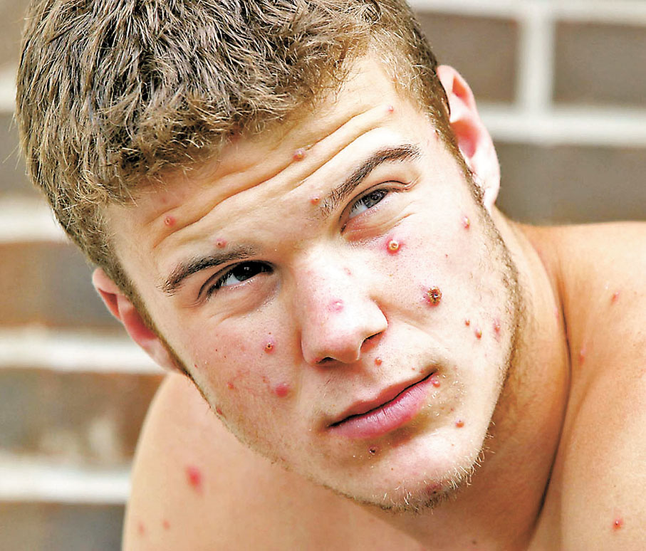 ◆猴痘患者面部及身體長出濃瘡。 資料圖片