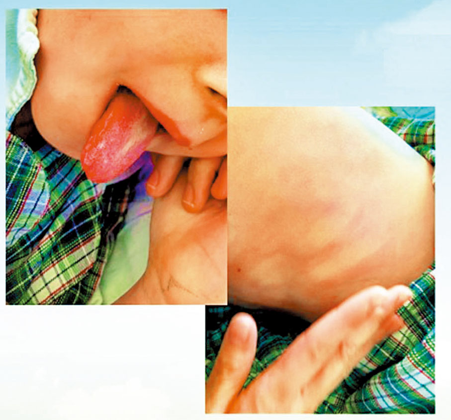 ◆染疫後康復10歲男童患上「兒童多系統發炎綜合症」，出現嘴唇乾裂及「草莓舌」等症狀。病人家屬供圖