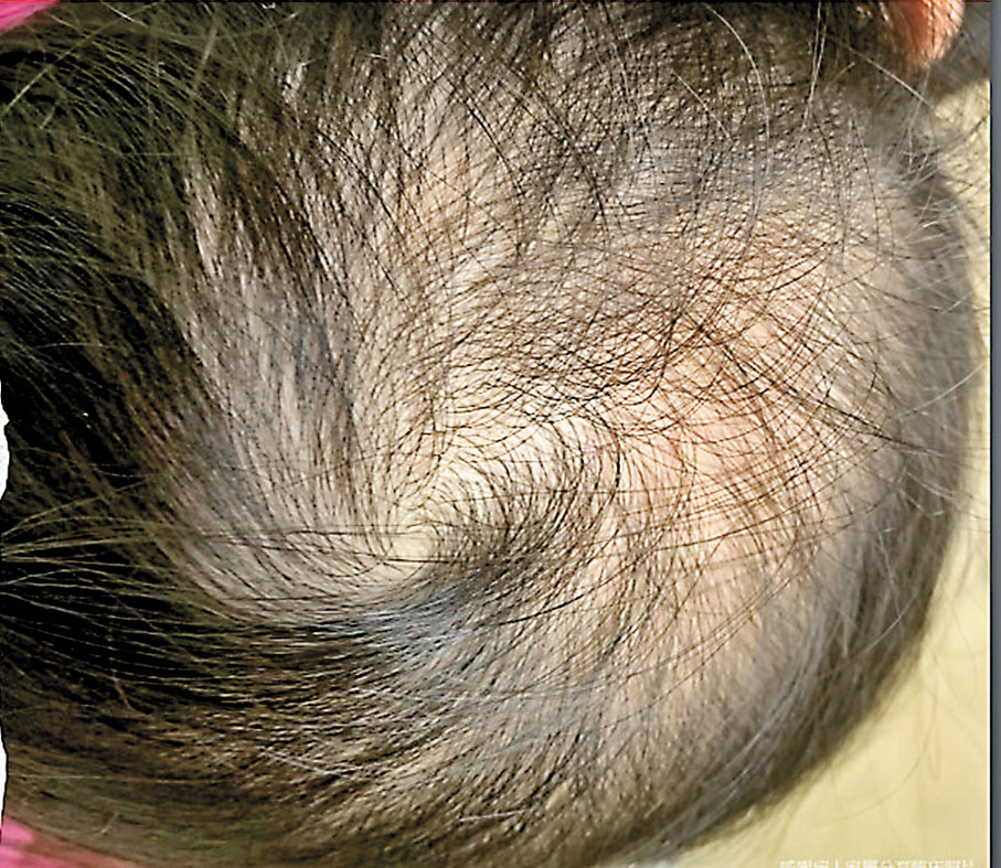 ◆有幼童脫髮數月未重新生髮。病人家屬供圖