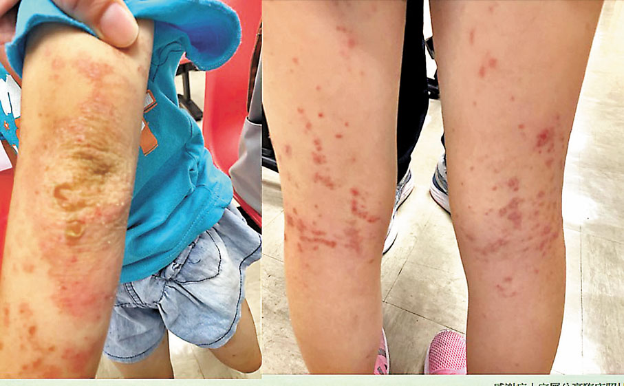 ◆個別長新冠兒童患者會出現濕疹症狀。病人家屬供圖