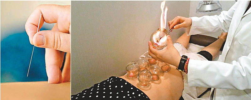 ◆中醫透過正骨復位等手法改善脊椎的排列，針灸、拔罐亦有助於緩和脊骨問題引起的痛症。