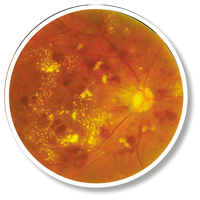 ◆罹患糖尿病視網膜病變的病人視網膜的影像。