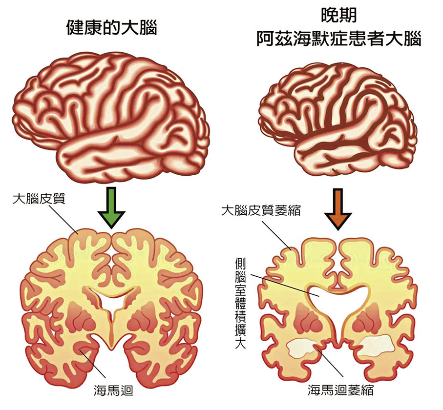 ◆正常腦部與患腦退化症腦部