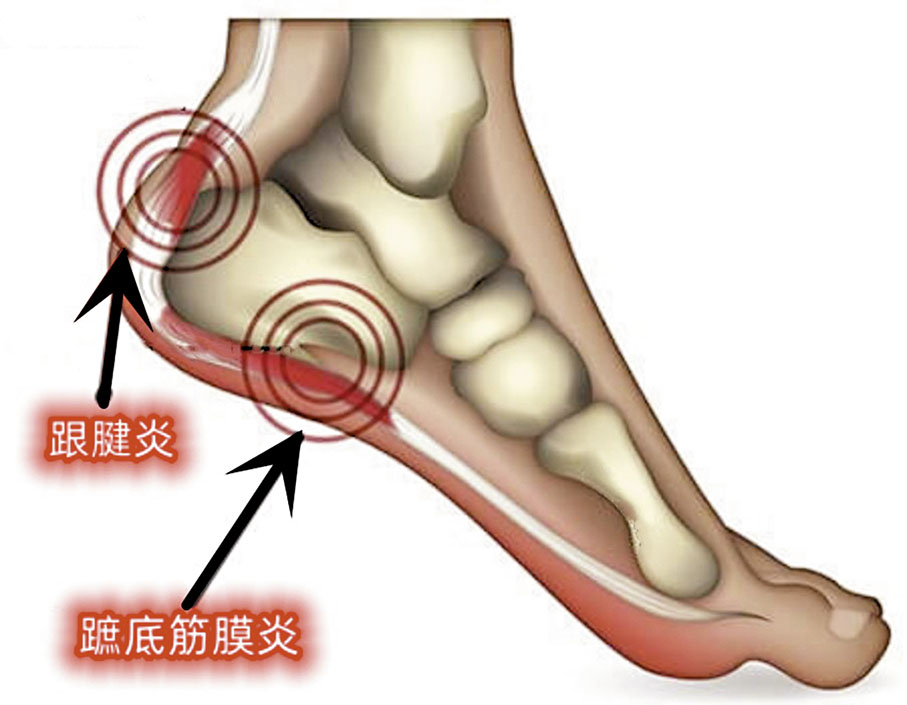 ◆足底筋膜炎及跟腱炎位置